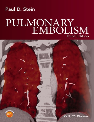 Pulmonary Embolism – AttentiveSons Store